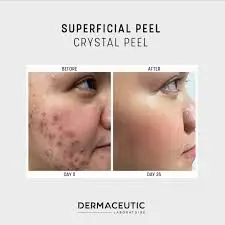 Crystal peel